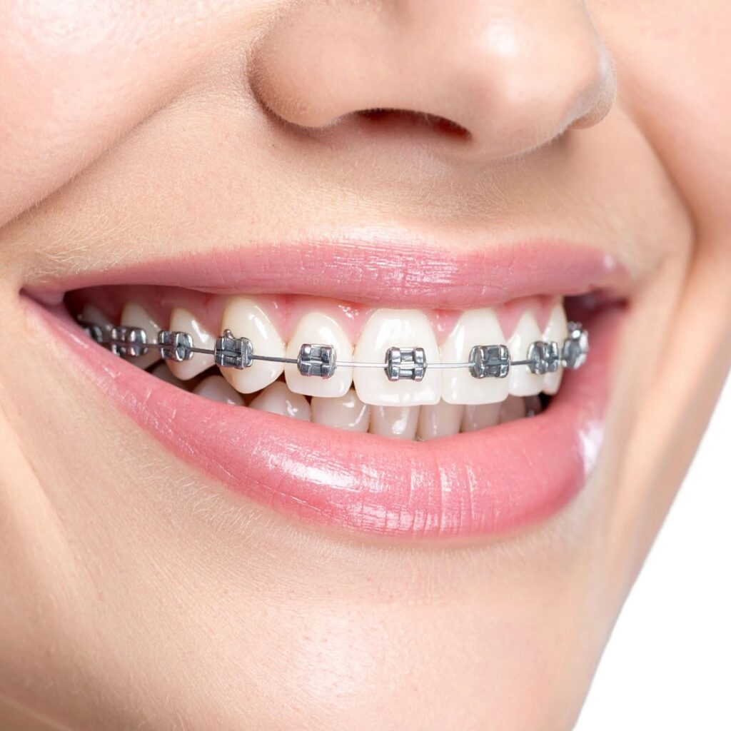 Festsitzende Zahnspange mit silberfarbenen Metallbrackets