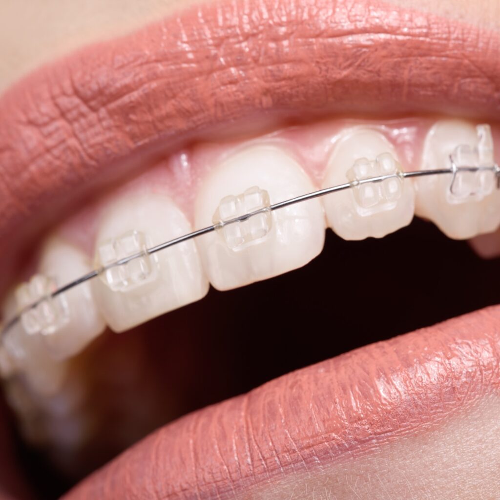Festsitzende Zahnspange mit weißen Keramikbrackets